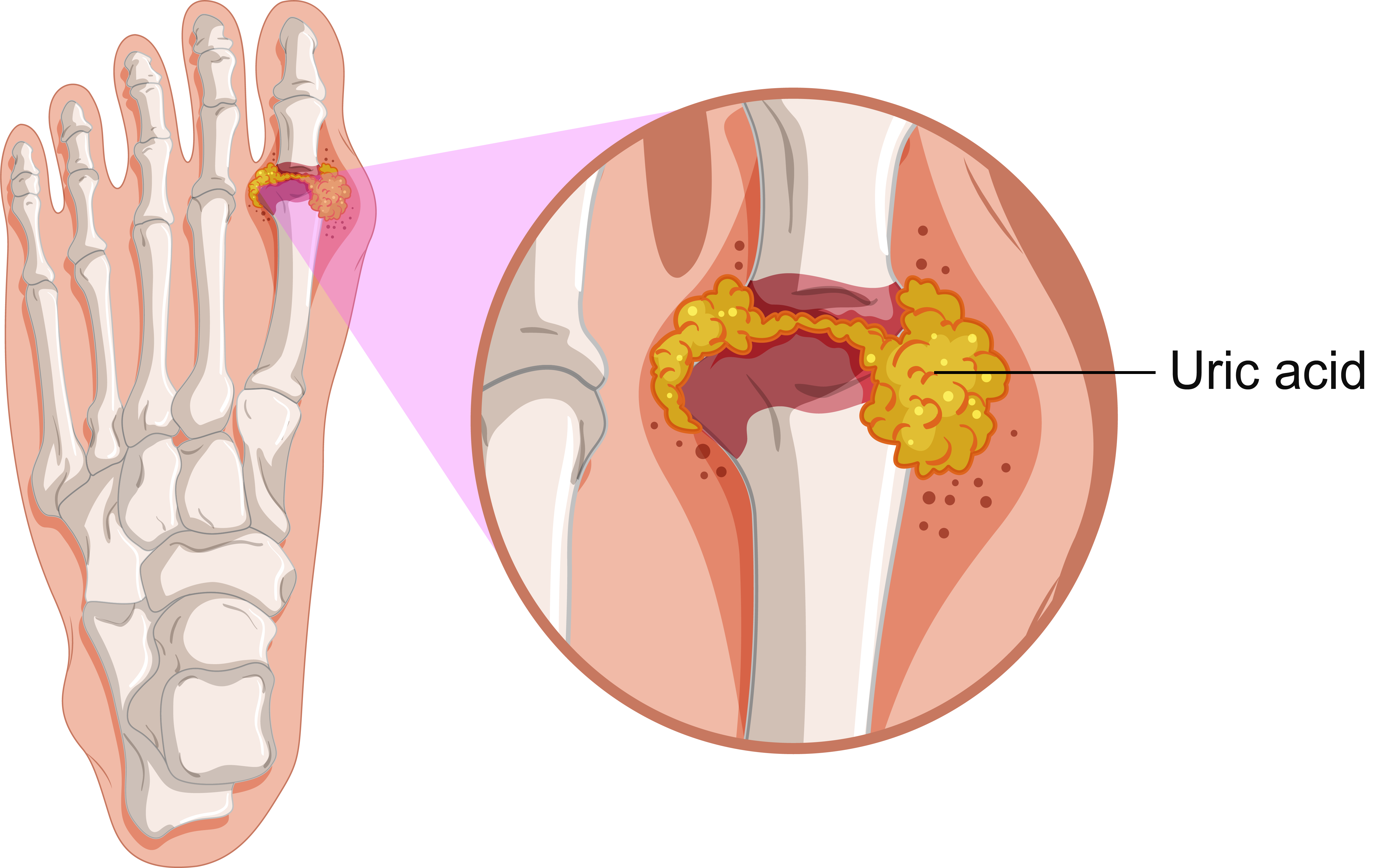 Bệnh gout